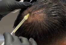 Can PRP Help Improve Bald Patches Naturally?