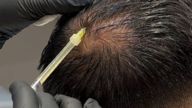 Can PRP Help Improve Bald Patches Naturally?