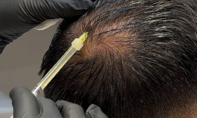 Can PRP Help Improve Bald Patches Naturally?